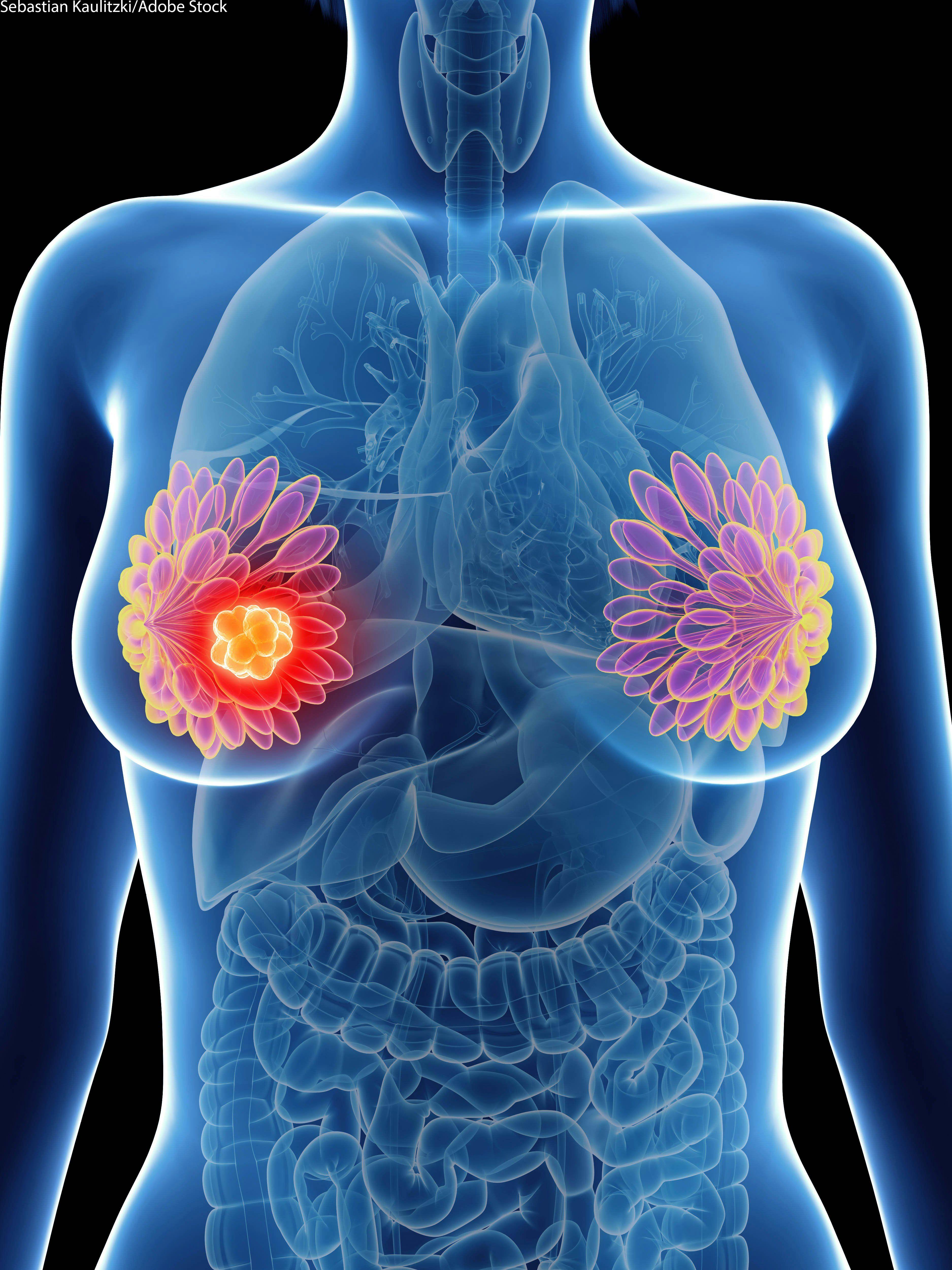 Patients with Invasive Secondary Breast Cancer May Have Higher Mortality