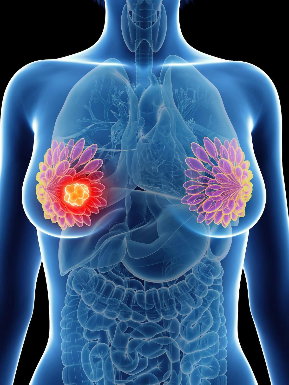 Findings from a phase 2 clinical study indicated that neoadjuvant pegylated liposomal doxorubicin plus cyclophosphamide, trastuzumab, and pertuzumab demonstrated promising efficacy and safety in the treatment of HER2-positive breast cancer. 