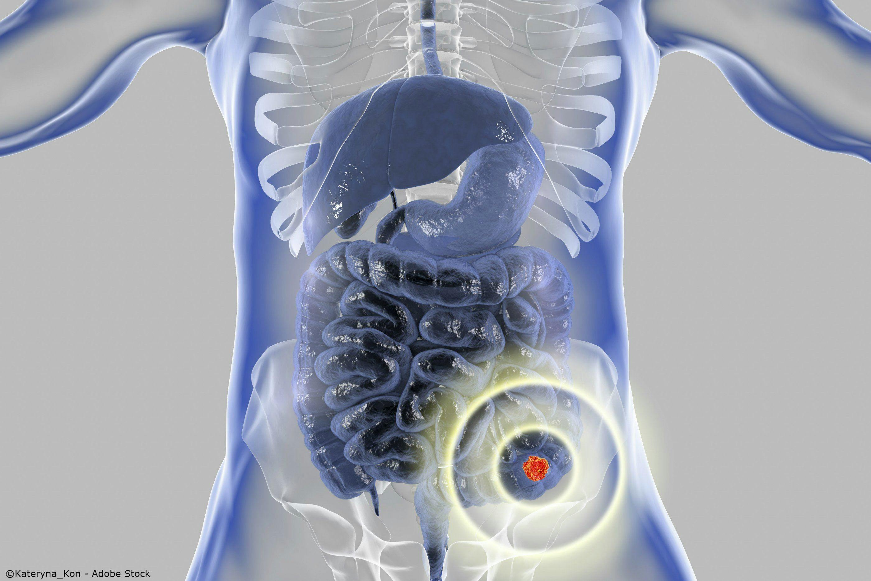 Circulating Tumor DNA May Identify Disease Progression in Patients with Rectal Cancer