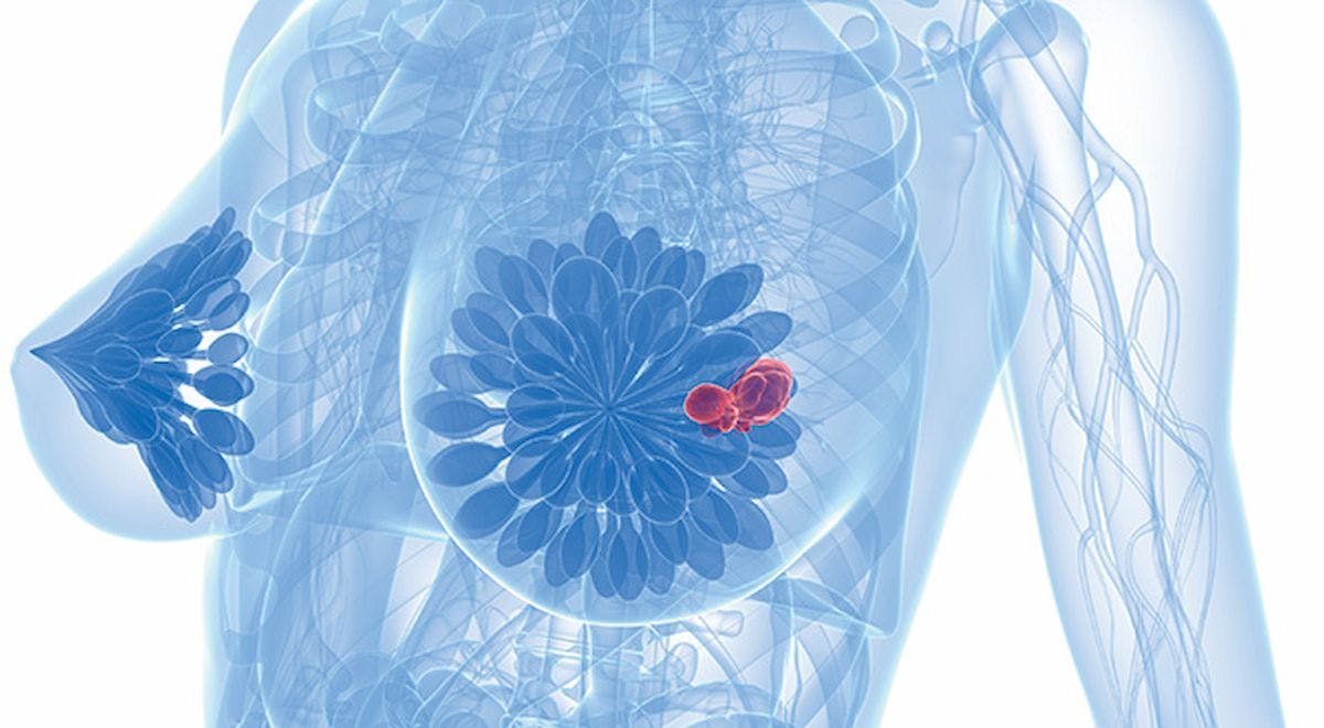 "This updated analysis continues to support sacituzumab govitecan as a standard treatment for patients with pretreated, endocrine-resistant [HR-positive/HER2-negative] metastatic breast cancer," according to Sara M. Tolaney, MD, MPH.