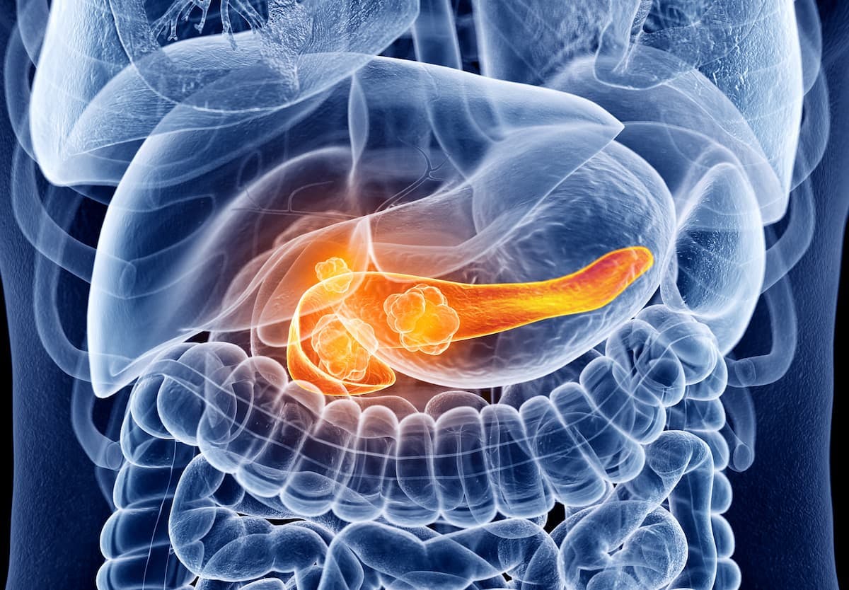 Investigators previously assessed the safety and tolerability of NT-I7 in combination with pembrolizumab as a treatment for those with pancreatic cancer and other advanced solid tumors as part of the phase 1b/2a NIT-110 or KEYNOTE PNA60 trial (NCT04332653).