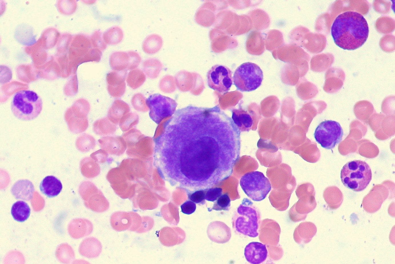 Safety data from the phase 3 COMMANDS trial were consistent with the overall safety profile of luspatercept for the treatment of anemia in patients with MDS who require red blood cell transfusions.