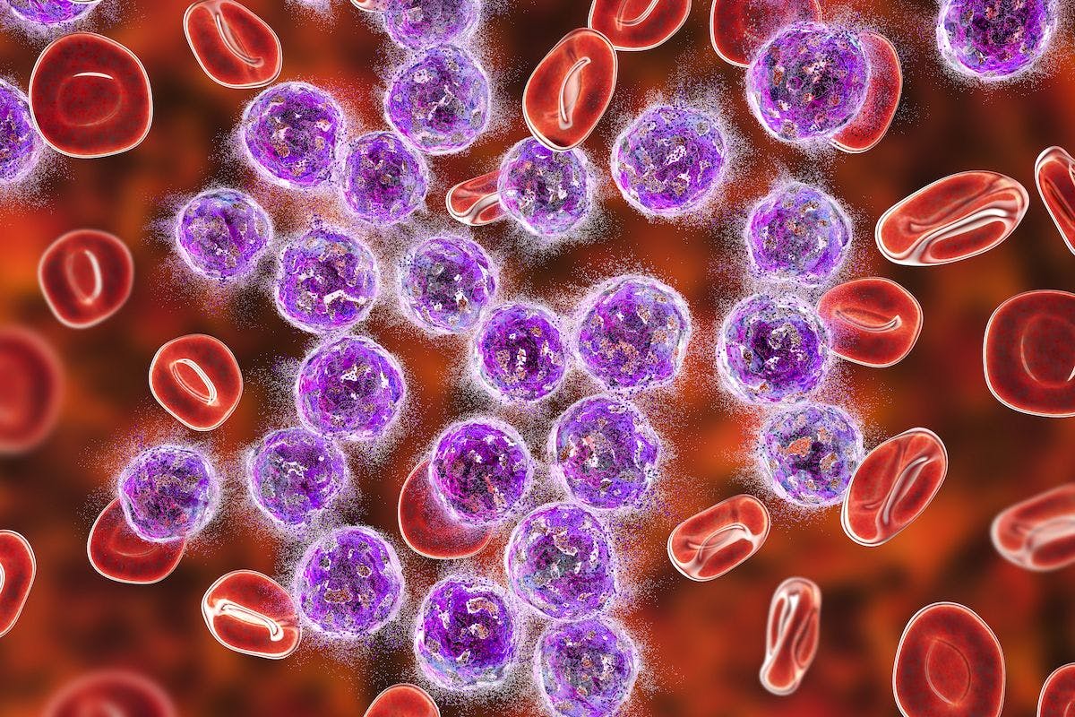 Data from the phase 3 VIALE-A trial showed continued responses during long-term follow-up for patients with newly diagnosed acute myeloid leukemia treated with venetoclax/azacitidine. 