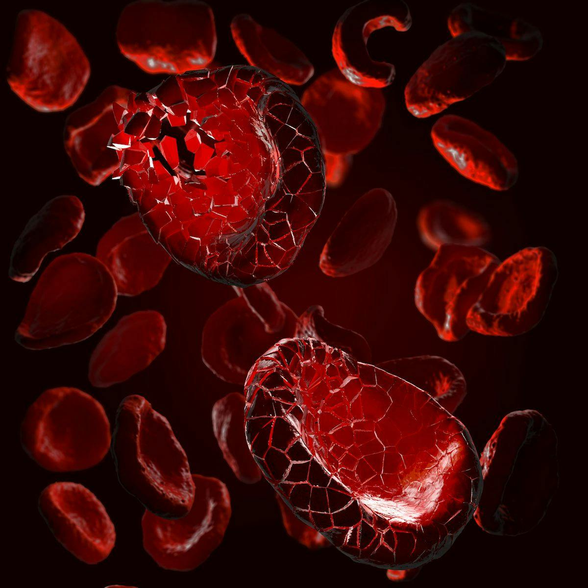 White Blood Counts Key to Managing Thrombotic Events in Polycythemia Vera